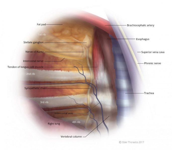 Bilateral VATS Endoscopic Thoracic Sympathectomy - Toronto Sweat Clinic